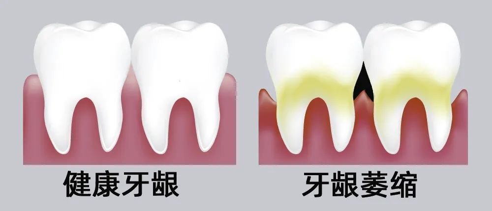 牙縫大露出“黑三角”，既塞牙又難看！還能恢復(fù)嗎？